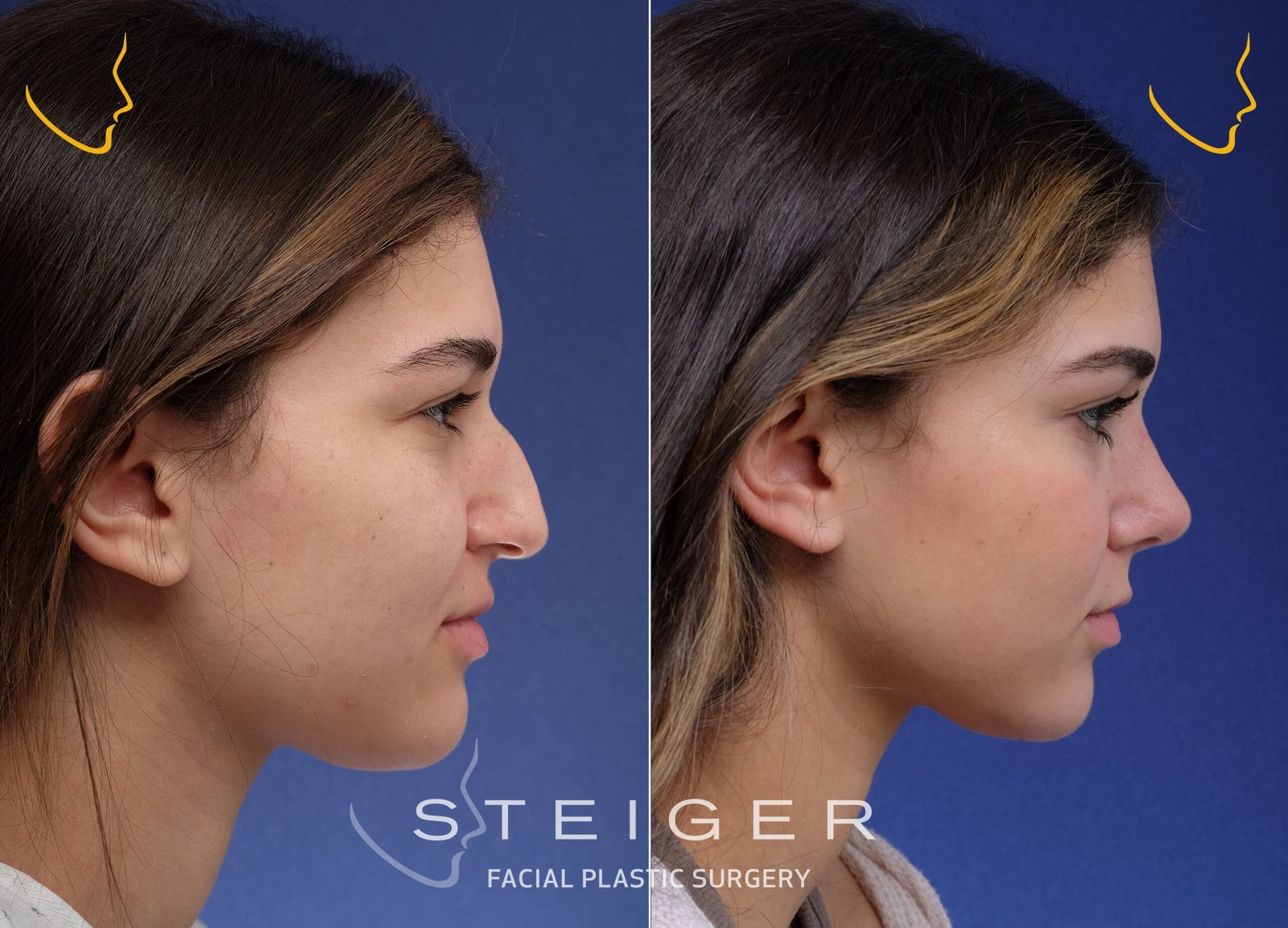 تجميل الأنف المتقدم - قبل