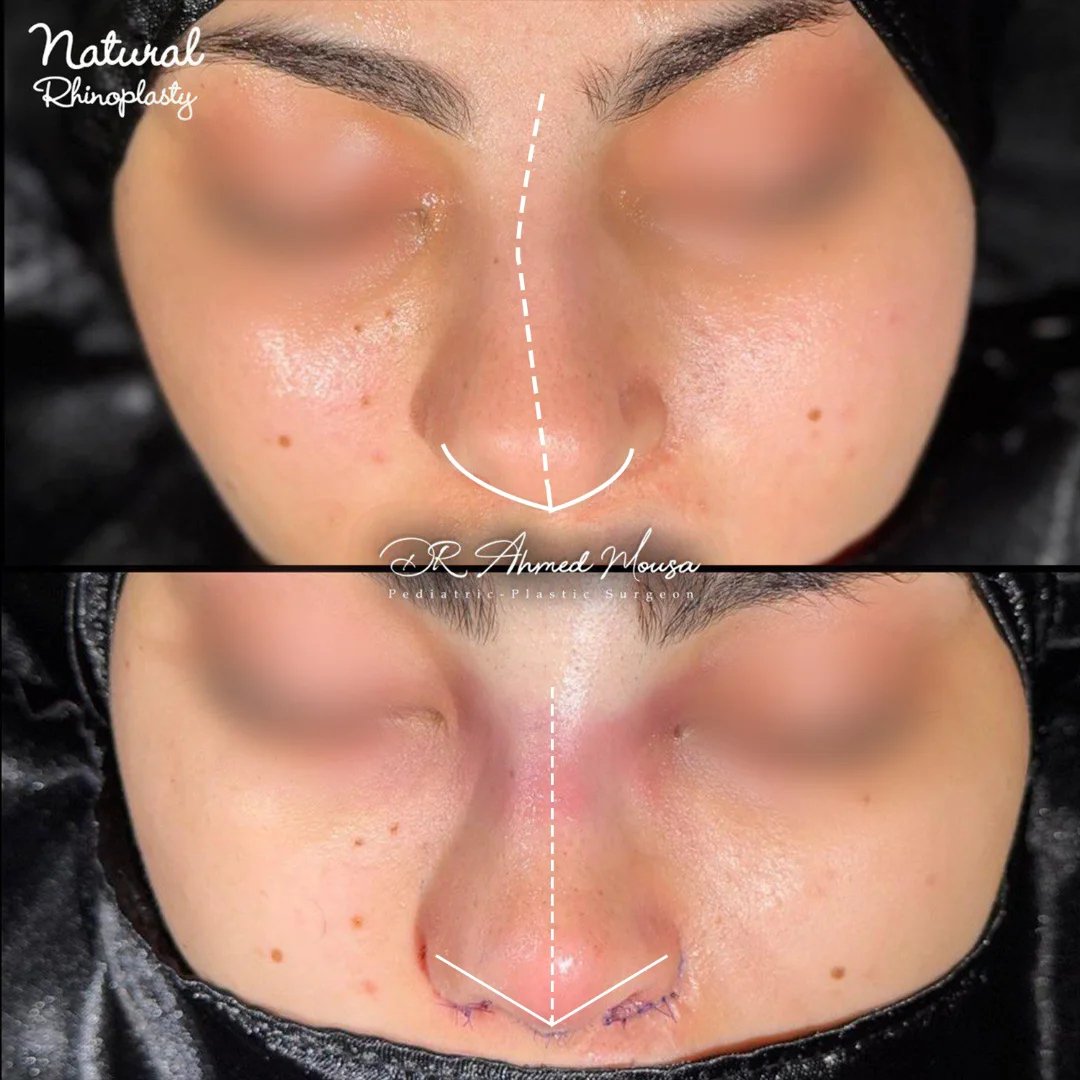 تجميل الأنف - حالة 1