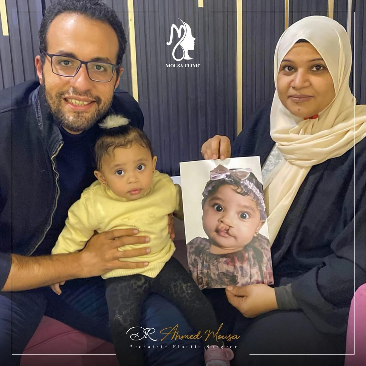 إصلاح الشفة الأرنبية - حالة 4