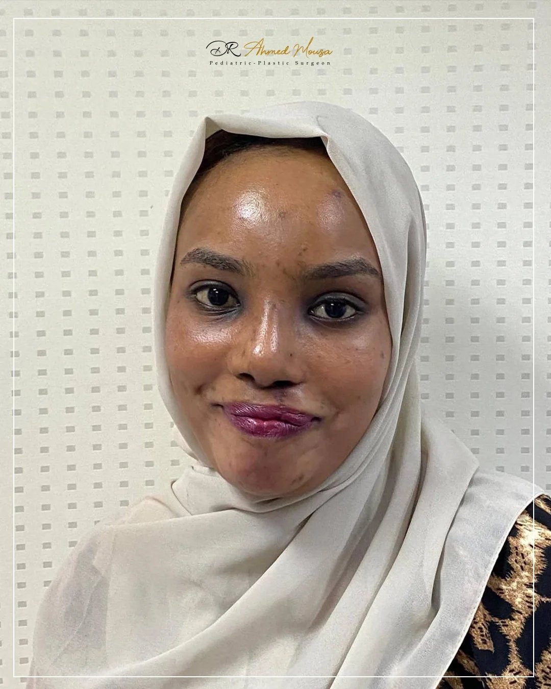 إصلاح الشفة الأرنبية - قبل