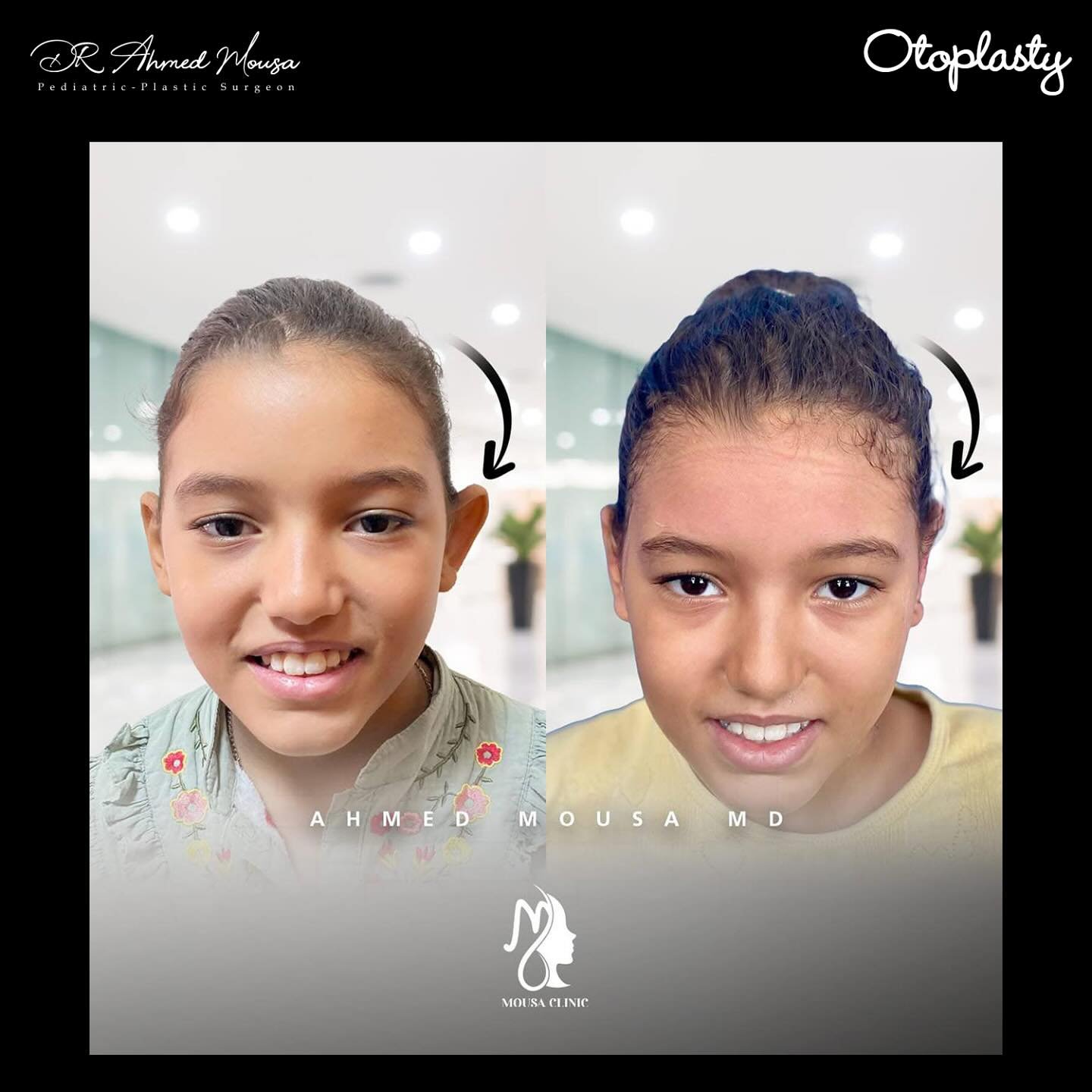 تجميل الأذن